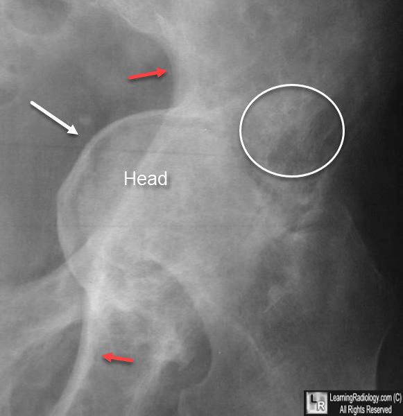 Acetabular Protrusio